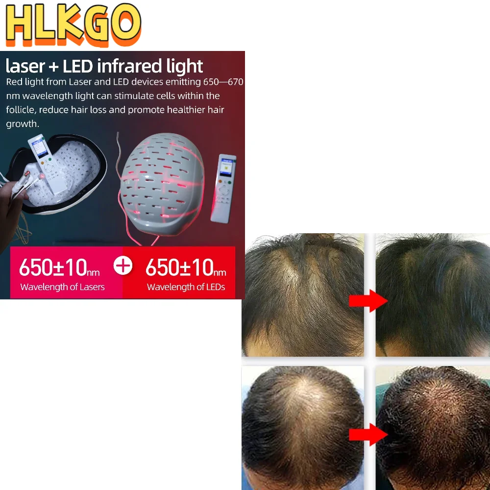 

Portable 6750mW Cold Laser Therapy Cap, Hair Regrowth Helmet with 300 Beams (90+210), Adjustable Power & Frequency