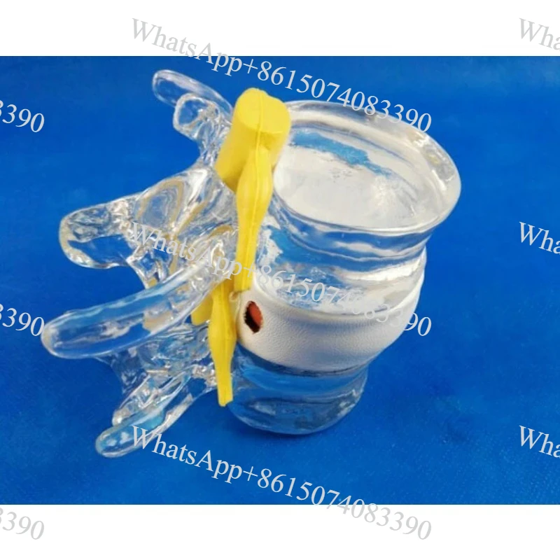Lumbar Disc Herniation Model 1.5X Life Size for Medical Teaching
