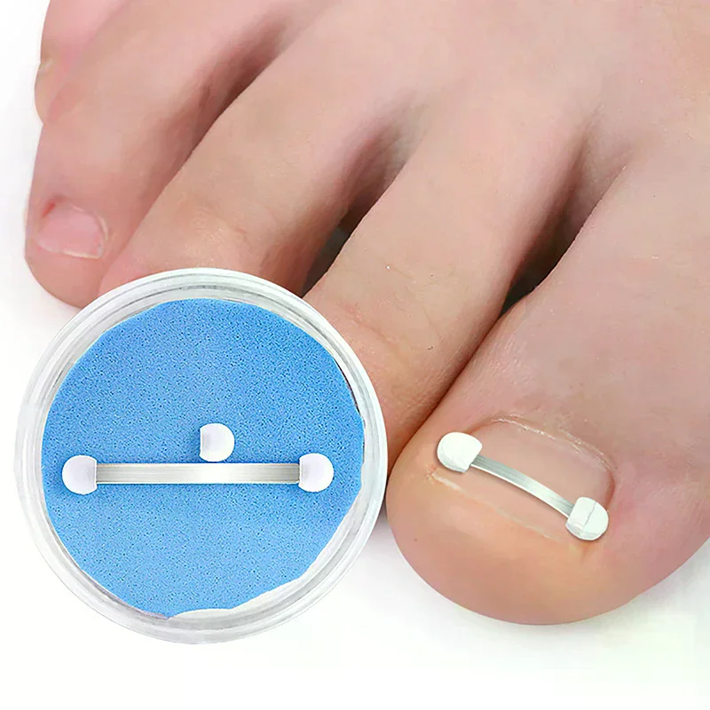 Ingrown Toenail Cor…