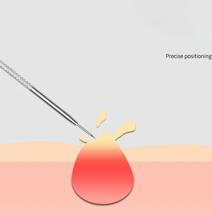 여드름 블랙헤드 제거 바늘, 피부 관리, 얼굴 청소, 여드름 제거 도구 키트, 모공 청소, 검은 점 제거
