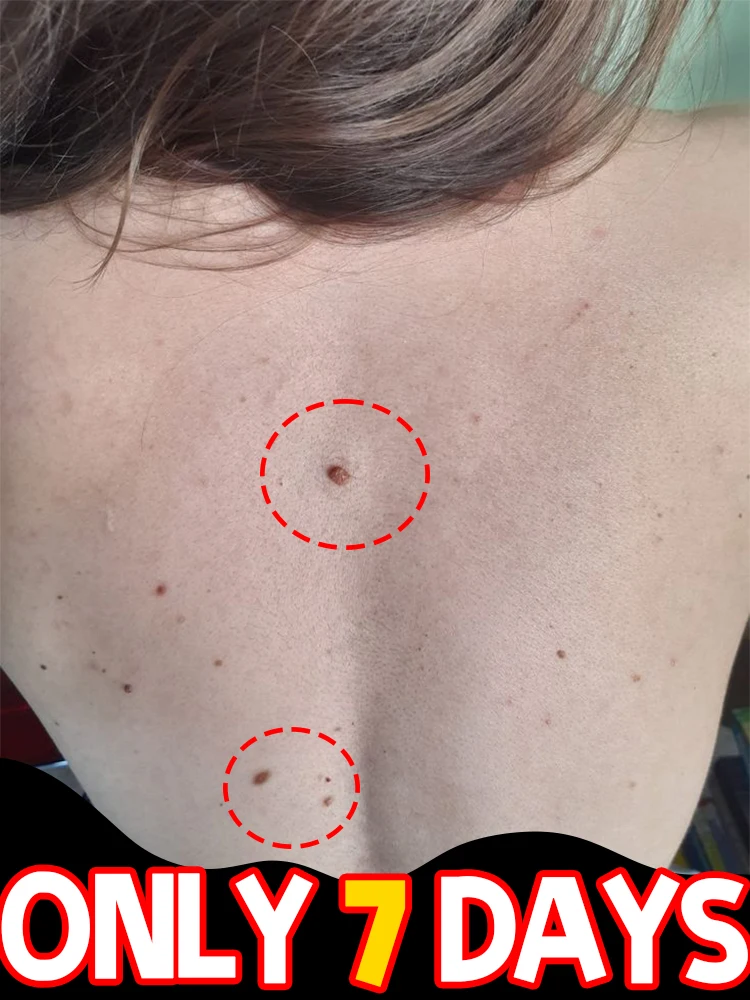 {2025 latest model}Deeply penetrate the dermis to say goodbye to warts at the root