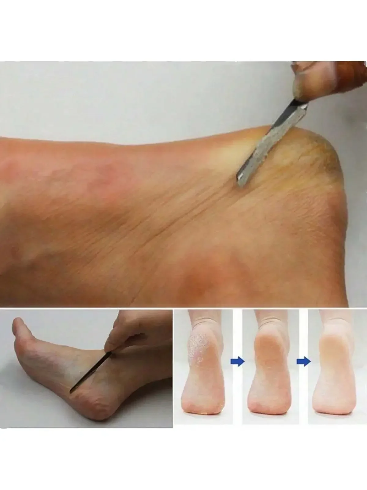 Tijeras para quitar cutículas, herramientas para el cuidado de los pies, Kit de uñas de acero inoxidable, juego de cuchillos de pedicura profesional, 2 piezas