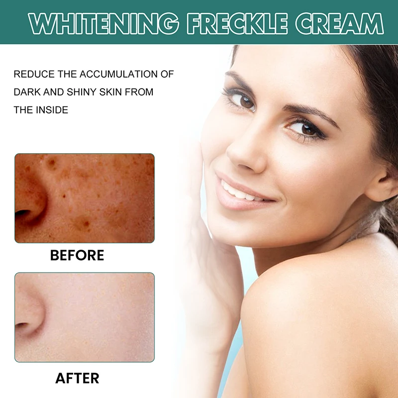 Niacinamida Melasma Brightening Creme, Reduzir O Clareamento De Melanina, Soro De Clareamento Da Pele, Fade Fine Lines, Cuidados Com O Rosto