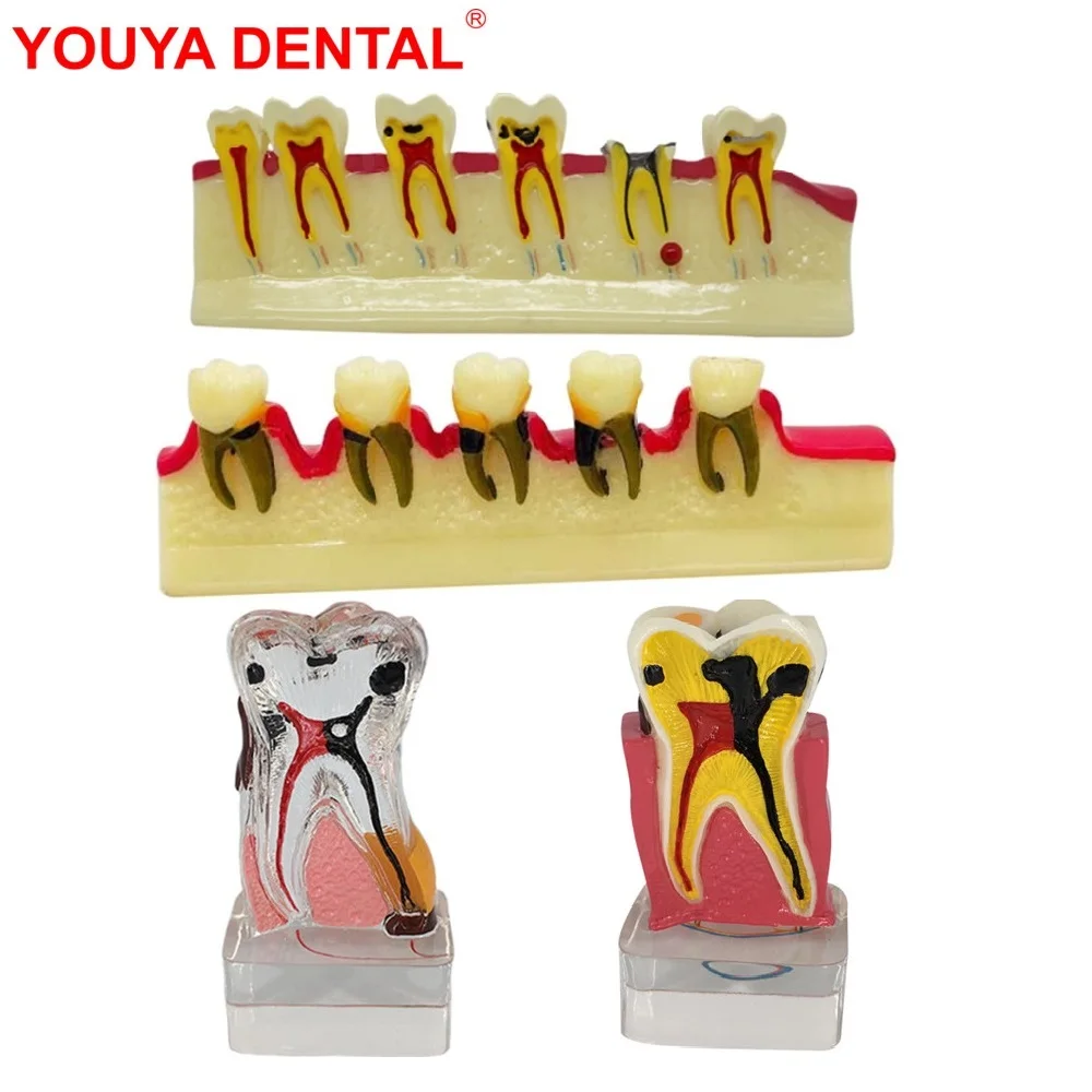 

Periodontal Disease Model Dentistry Tooth Model Periodontitis Dental Teeth Model for Studying Teaching Education Demonstration