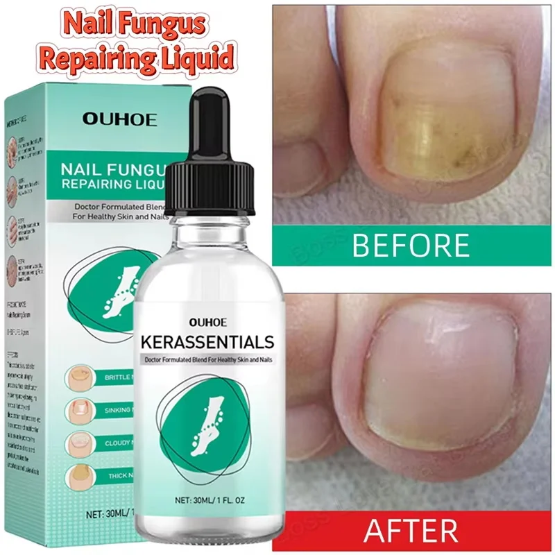 اضافية قوية علاج فطريات الأظافر مصل جوهر العناية بالزيت إصلاح جوهر مكافحة تو العدوى هلام قدم كريم إزالة الأظافر الفطريات