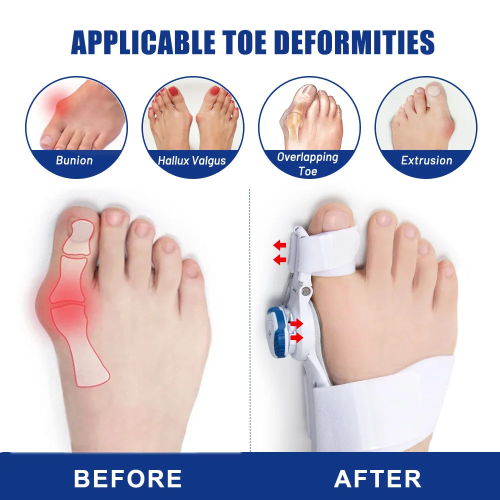 Orthopedisch Bunion Corrector Apparaat Voetverlichting Hallux Valgus Teen Correctie Pedicure Voeten Bot Duim Versteller Voet Massager