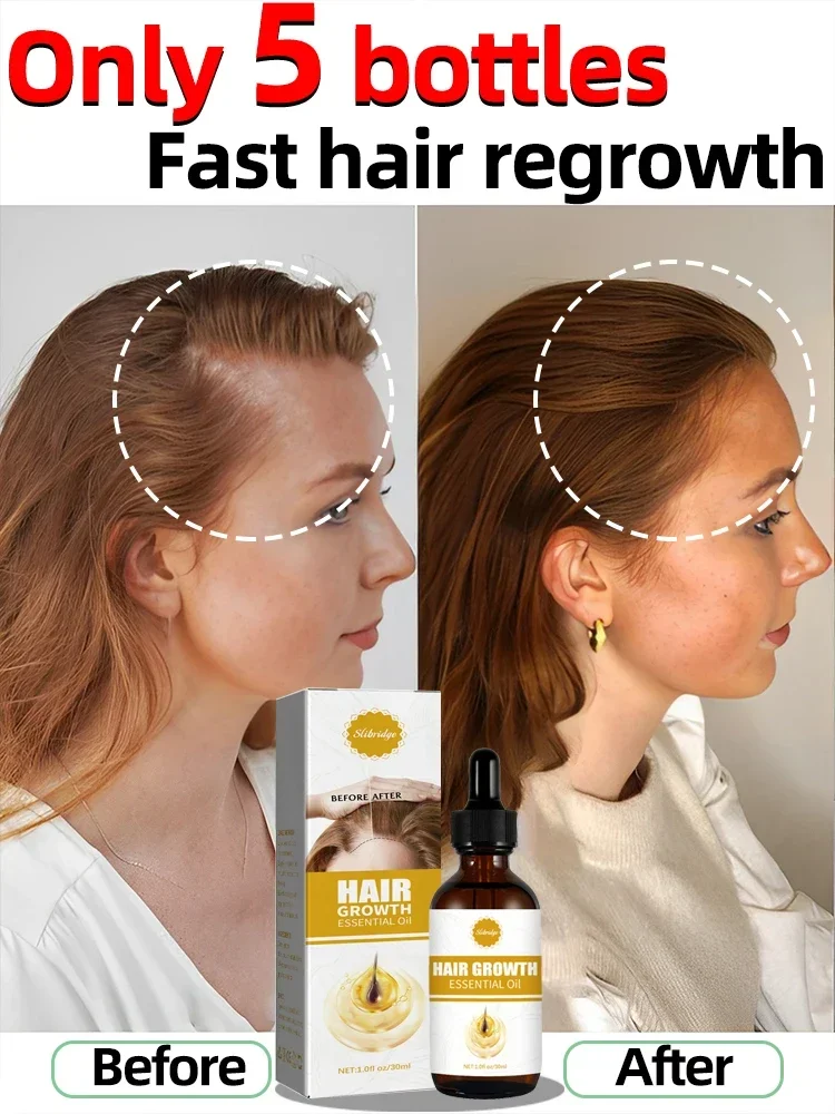 

O óleo de crescimento capilar faz o cabelo crescer rapidamente, repara eficazmente a calvície e a queda de cabelo hereditária