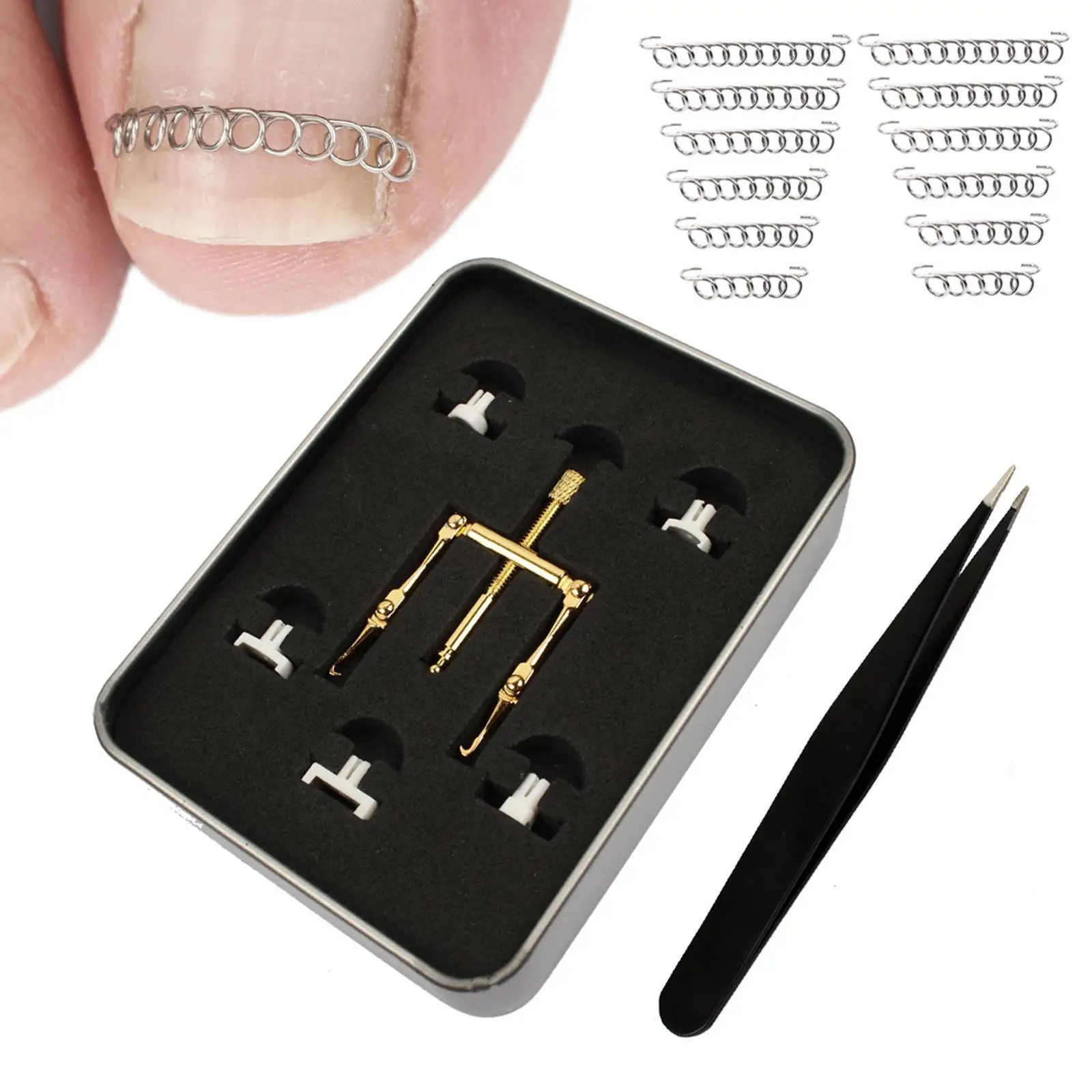 علاج أظافر القدم الغارزة، مشبك تنعيم للأظافر