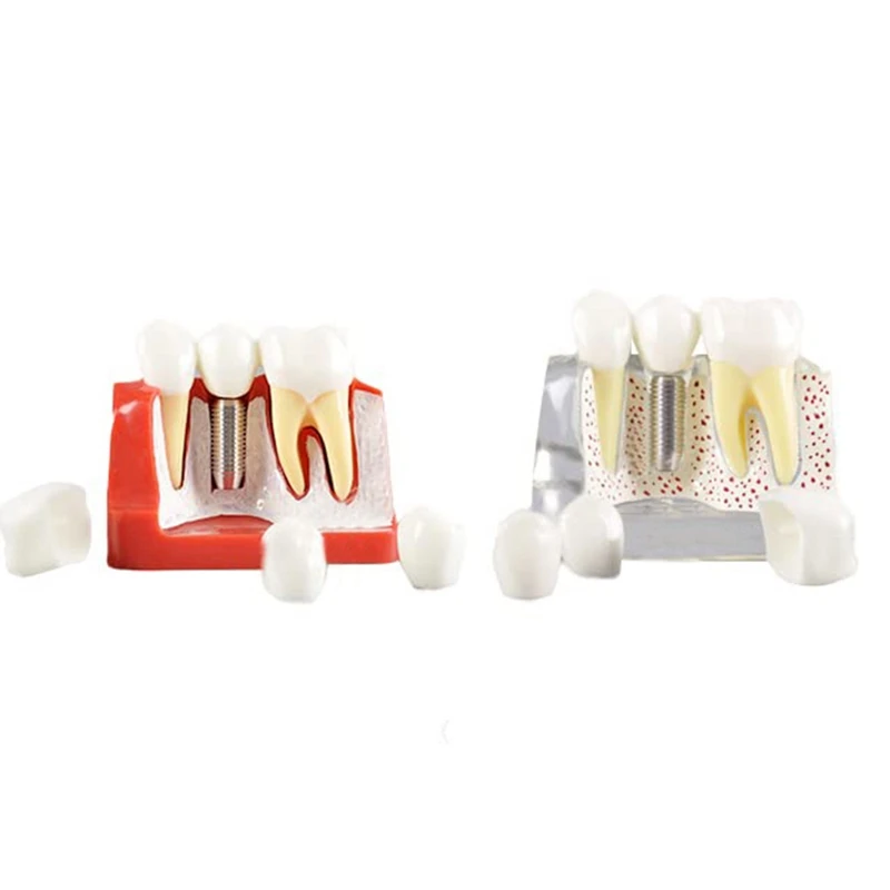 Modèle de Démonstration des Dents Implant PerfecAnalysis Couronne Pont pour la Communication-Patient
