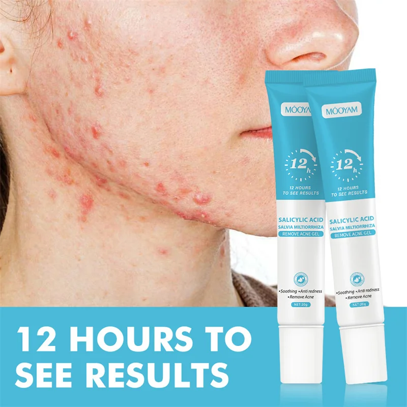 Acne Cream For Face Pimples Remover Treatment Shrink Pores Oil Control Lighten Acne Marks Whitening Smoothing Facial Skin Care