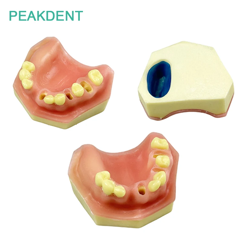 

Dental Dental implant model maxillary Sinus Implant Missing Tooth Model Dental Research And Teaching