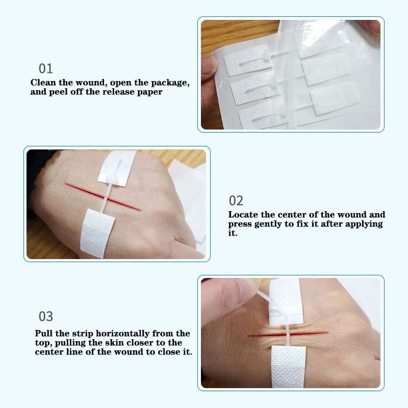 Outdoor Portable Band-Aid Zipper Tie Wound Closure Patch Hemostatic Patch Wound Fast Suture Zipper Band-Aid