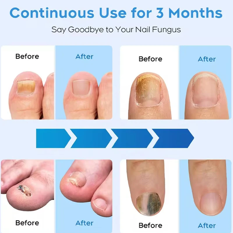 جهاز ليزر فطر الأظافر الفطرية KTS ، إصلاح فطار الأظافر ، أظافر القدم ، يزيل فطريات الأظافر ، العناية بالقدم #4