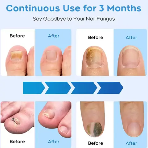 10 best sales फंगस नाखून उपचार - №5