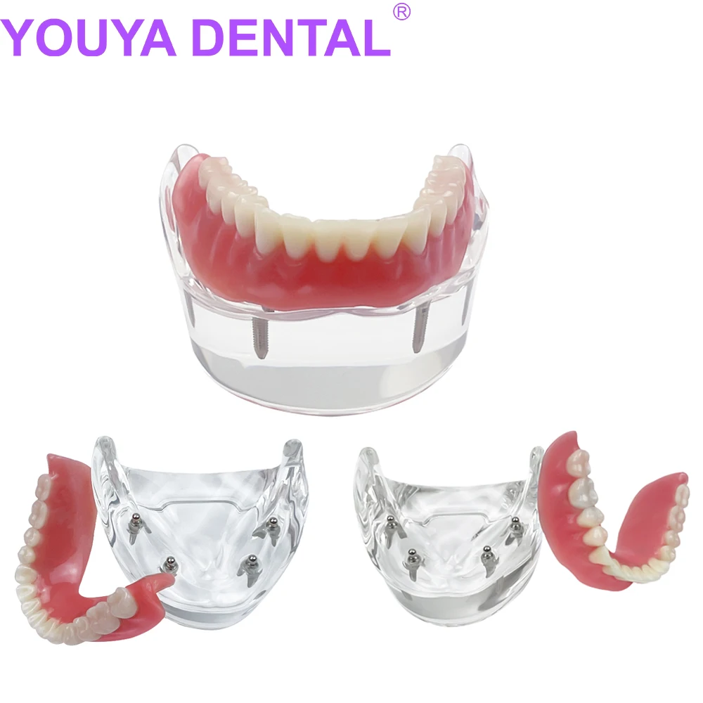 

Teeth Implant Model Dental 4 Implant Overdenture Restoration Lower Teeth Model Dental Teaching Model Dentist Demonstration Tools