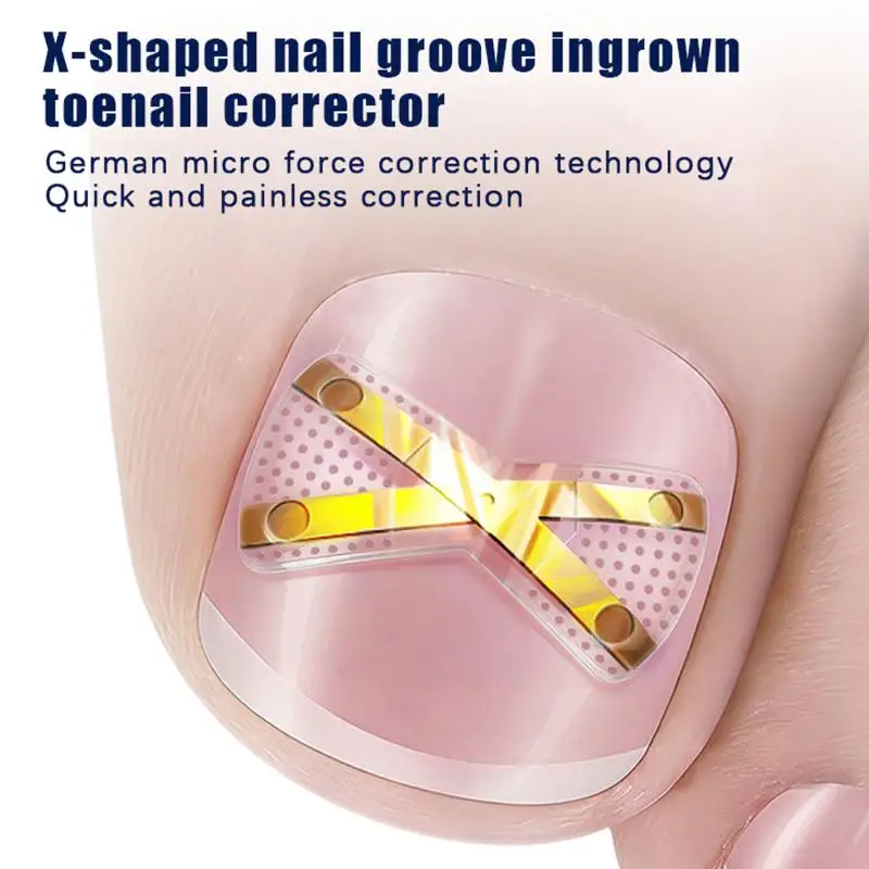 X-shaped Ingrown Toenail Correction Tool Ingrown Toenail Treatments Elastic Patch Sticker Toenail Straightening Pedicure Tool