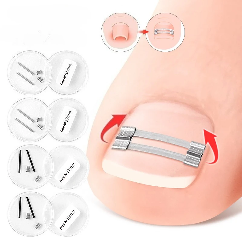 15/17mm Ingrown Toenail Corrector Clip Brace Tools Pedicure Recover Embed Toe Nail Treatment Professional Toenail Straightenings