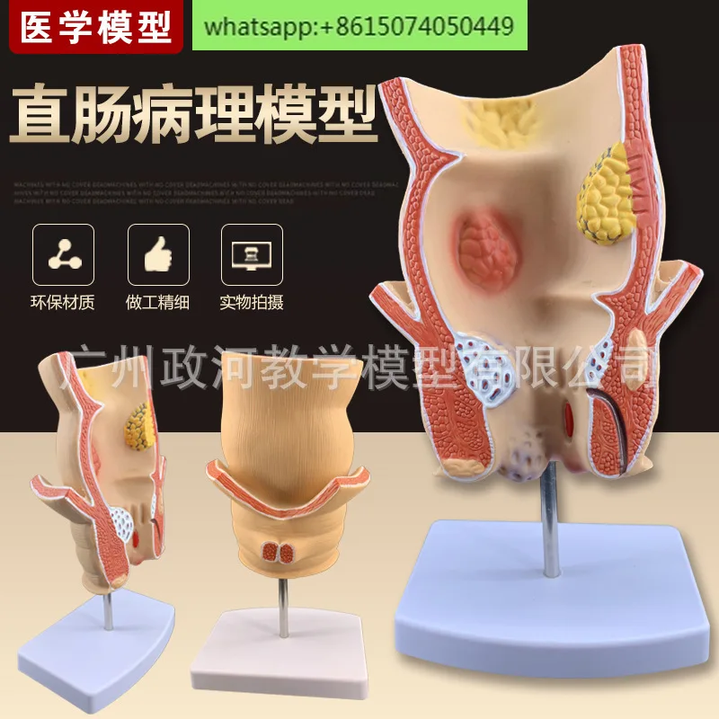 simulation rectal pathological model, intestinal specimens, human anatomy model, hemorrhoids, anal lesions, teaching aids