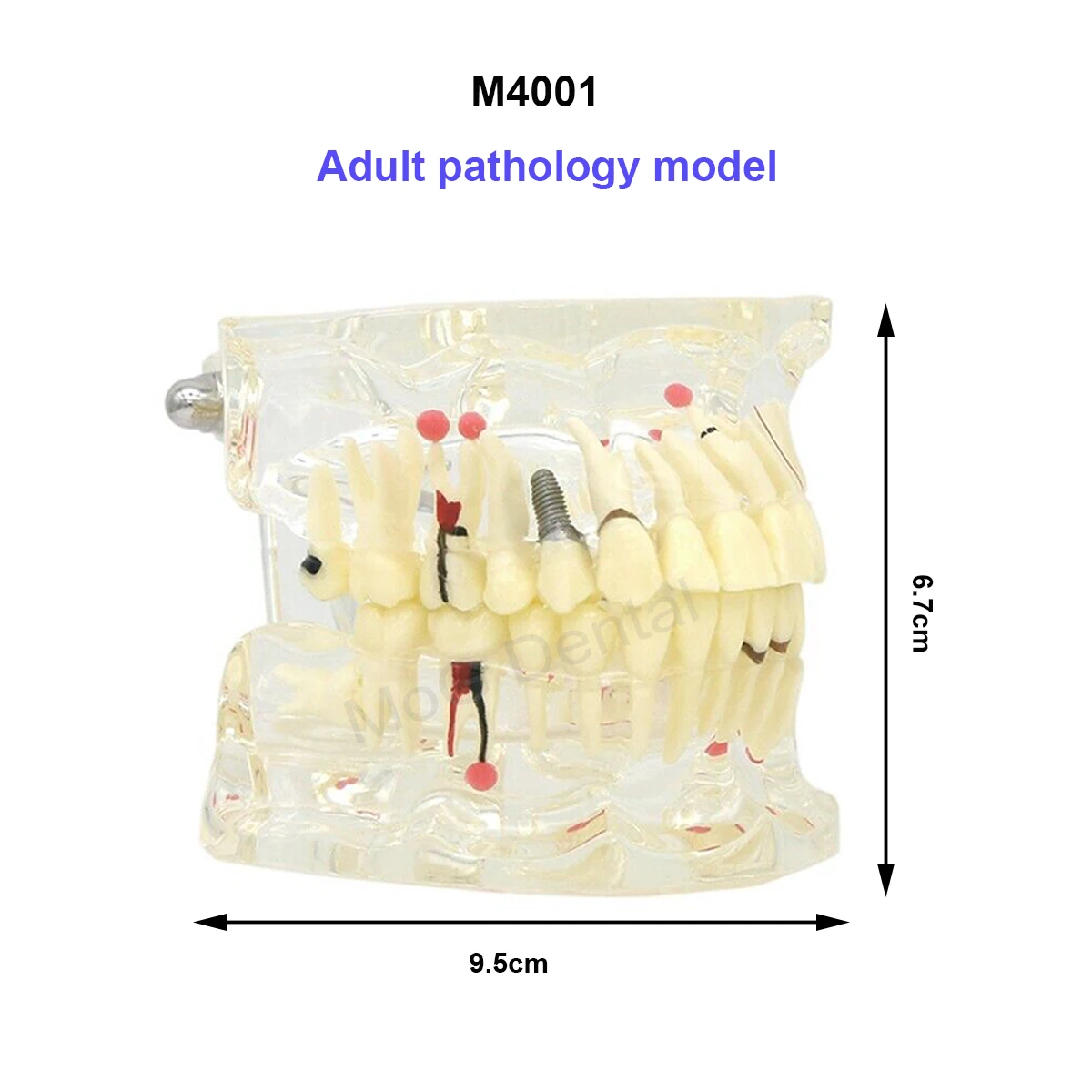 Dental Pathological Teeth Model with Adult and Children Tooth Dismountable Models Dentistry Model For Student Study Teach Demo