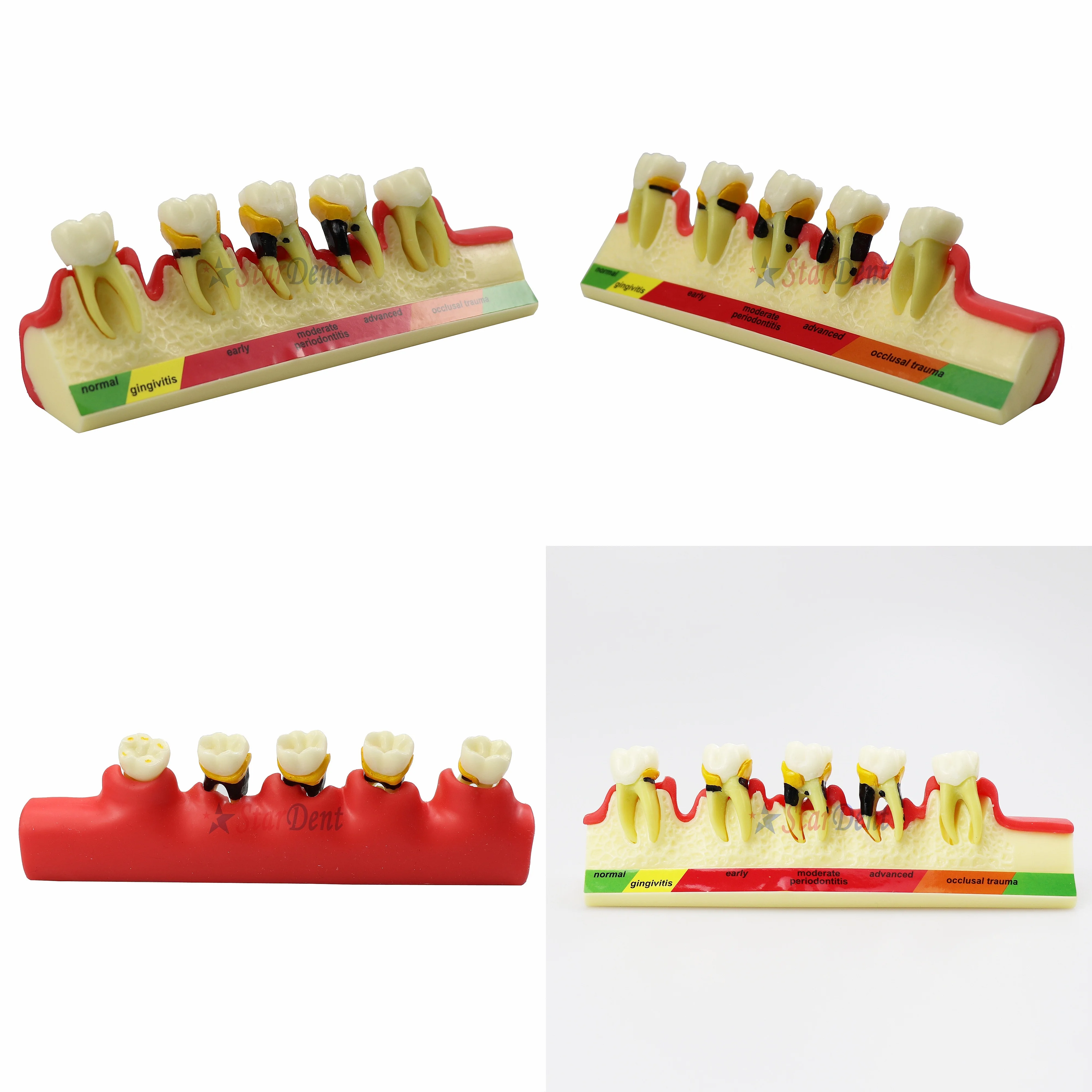 Periodontal Disease Model Resins Dentals Teeth Model for Student Teaching Denture Practice