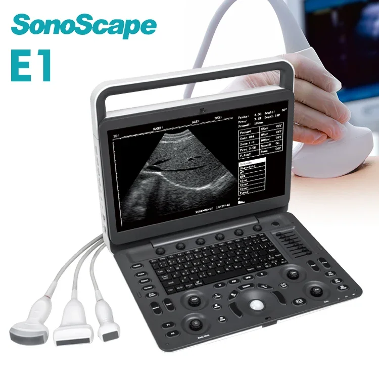 Sonoscape E1 E2 Medical Ultrasound Instruments 4d Ultrasound Portable Ultrasonic Diagnostic Devices