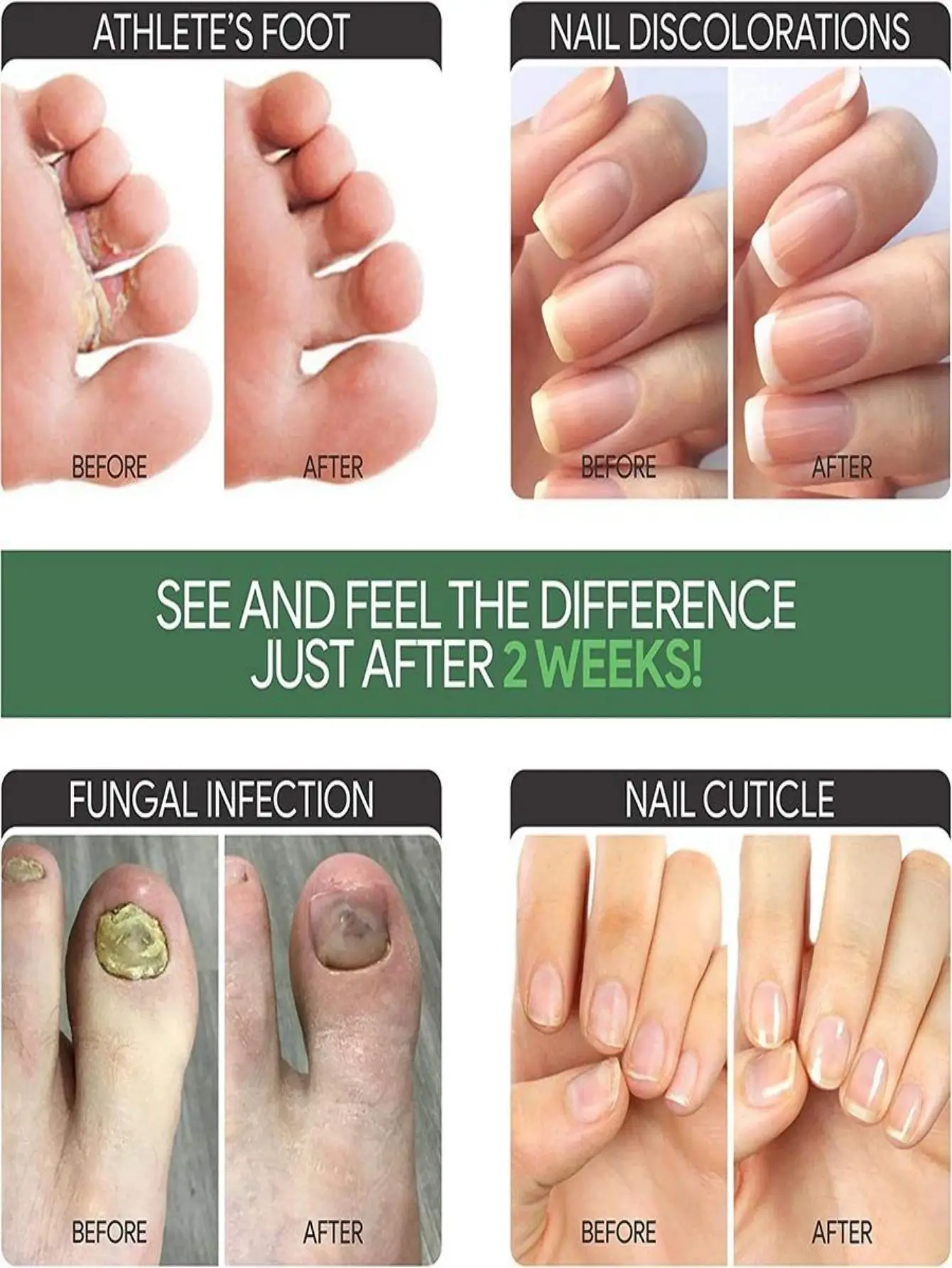 Nail Fungus Treatment Feet Care Essence Nails Foot Repair Toe Nail Fungal Removal Onychomycosis Gel Anti Infection Paronychia