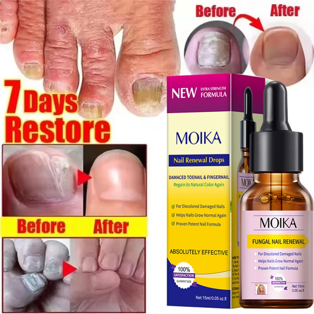 جديد علاج الأظافر الفطرية مصل القدم فطريات الأظافر إزالة إصلاح هلام مكافحة العدوى الداحس فطار الأظافر الرعاية جوهر