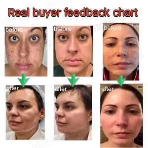 Lekeleri çıkarmak için krem ağartıcı, ciltte güçlü ışık, melanin pigmentini, melazma koyu lekelerini, nemlendiriciyi, güzelliği, jeli hızla giderir 1 Numaralı yüzdeki melazmaya ürünün 6 büyük satışı