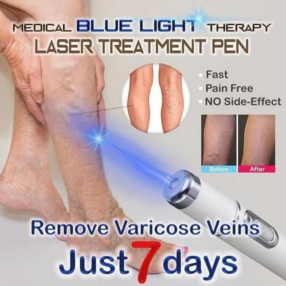 Blue Light Therapy Varicose Vein Pen Medical Varicose Scar Vein Pen Light Blue Acne Therapy Treatment