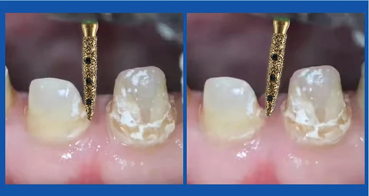 6-teiliges AZDENT Dental-Diamantbohrer-Restaurationsset mit Box, vertikale Präparationsbohrer für vordere Prämolaren, Zahnmedizinische Instrumente – Detail 12