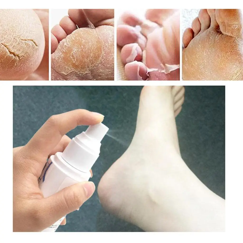 Callus Eliminator Spray Gentle Nourishing Feet Exfoliator Dead Skin Remover for Dry Cracked Heels