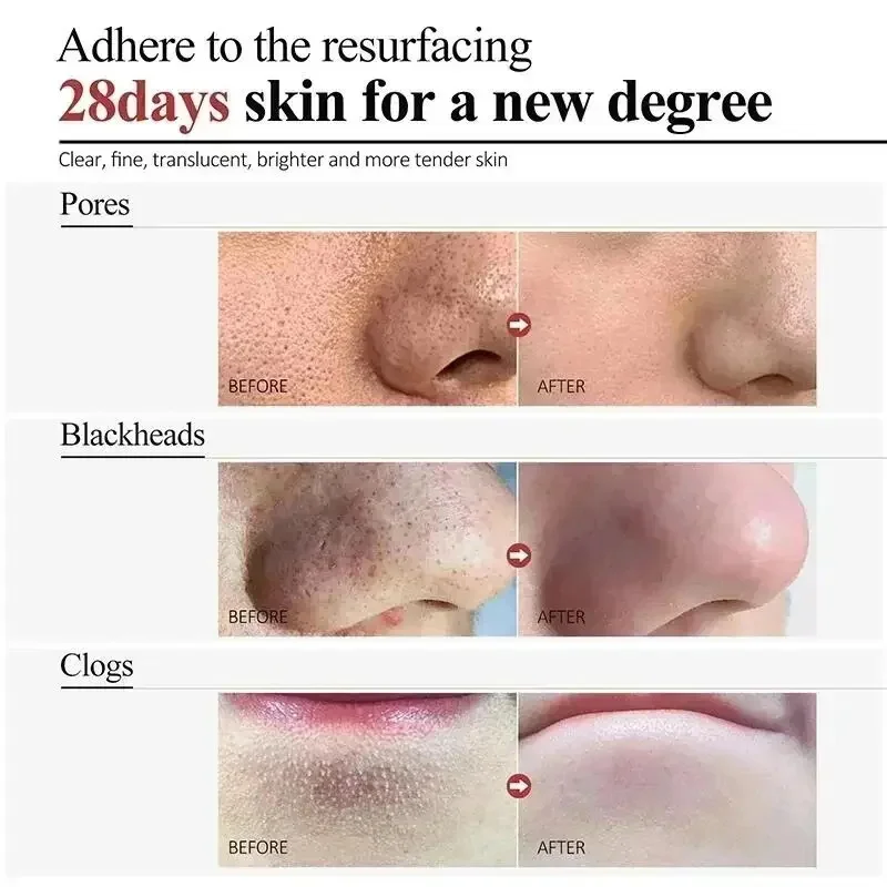 Salicylic Acid Pore Clearing Cream Shrink Pores Remove Blackheads Acne Brighten Moisturizing Smooth Skin Care Korean Products