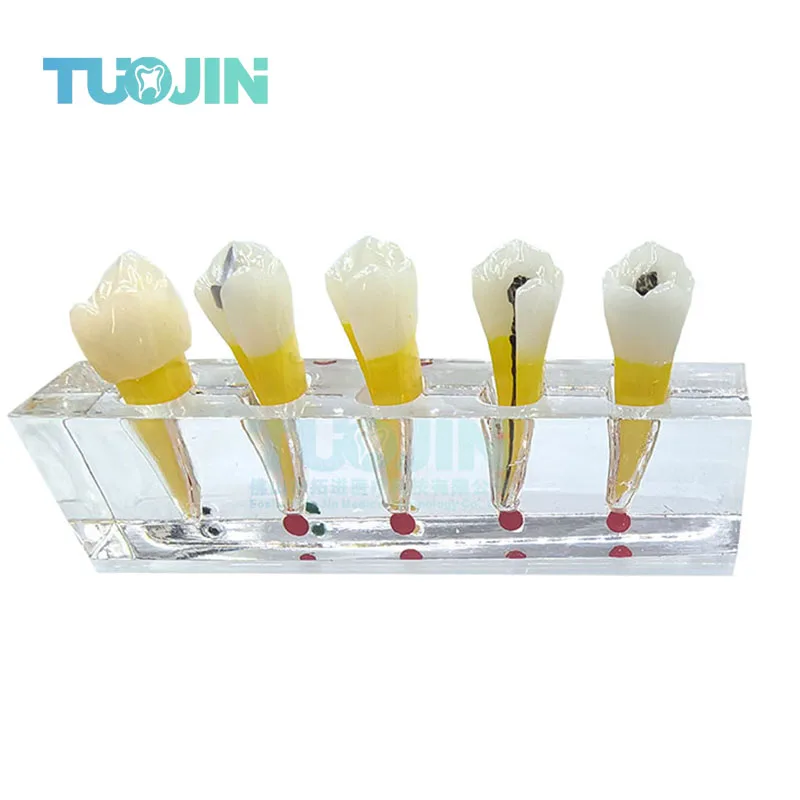 

Эндодонтическая патологическая модель, патология, модель связи пациента, эндодонтическое лечение, задние зубы, восстановление зубной пульпы