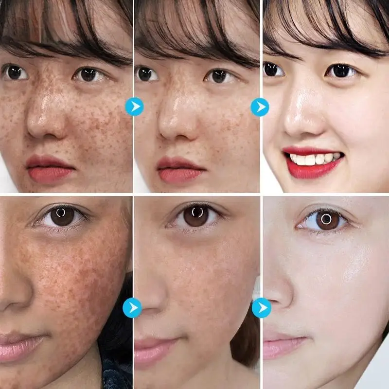 Nepopsaný pleť krém sytý bělení piha krém přemístit melasma akné skvrn barvicí prostředek melaninu temný skvrn obličej péče krém pleť