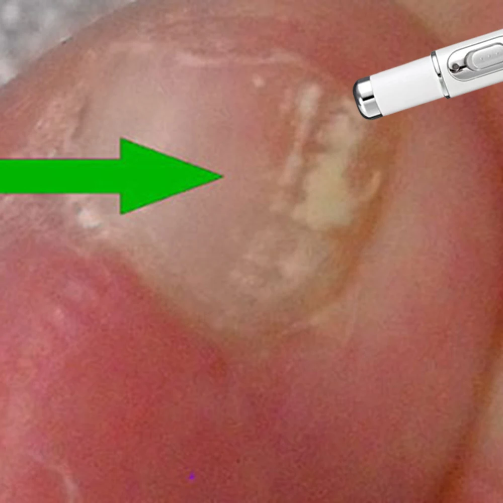 

Fungal Nail Laser Device Removal Care Tool Repair Toenail Fingernail Nail Fungus Laser Device Fungal Nail Onychomycosis