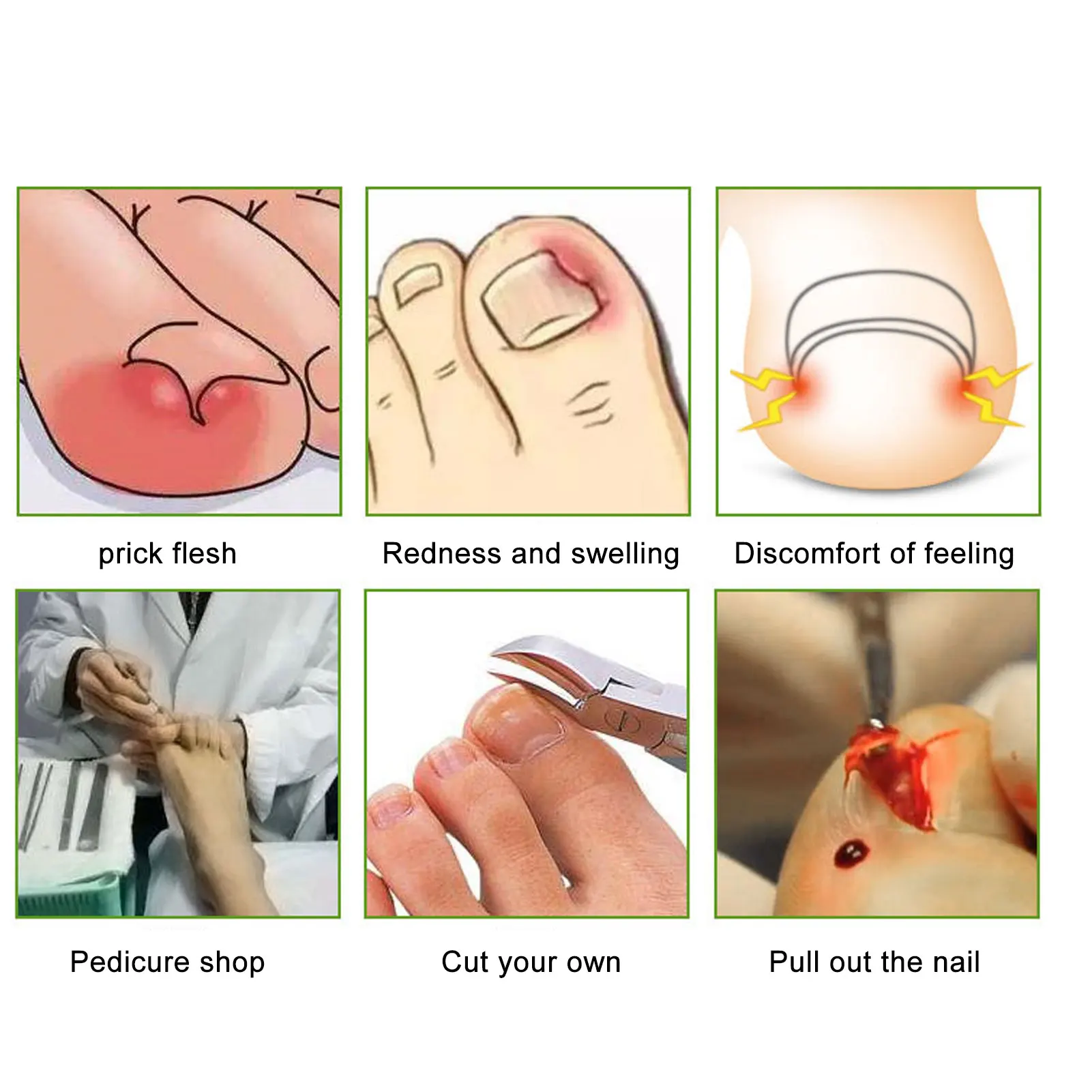 10 pz Strisce di Correzione dell'unghia del piede Brace Elastico Cambio Direzione della crescita Tutore di Correzione dell'unghia del piede incarnita Strisce di correzione dell'unghia del piede