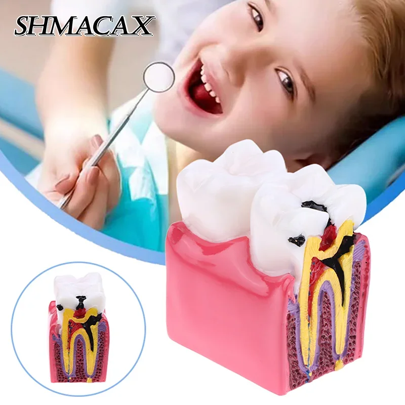 

6-кратная модель кариеса, заболевания зубов, стоматологическая модель для стоматологической демонстрации, модель стоматолога, обучение, стоматологическая лаборатория, исследование полости рта