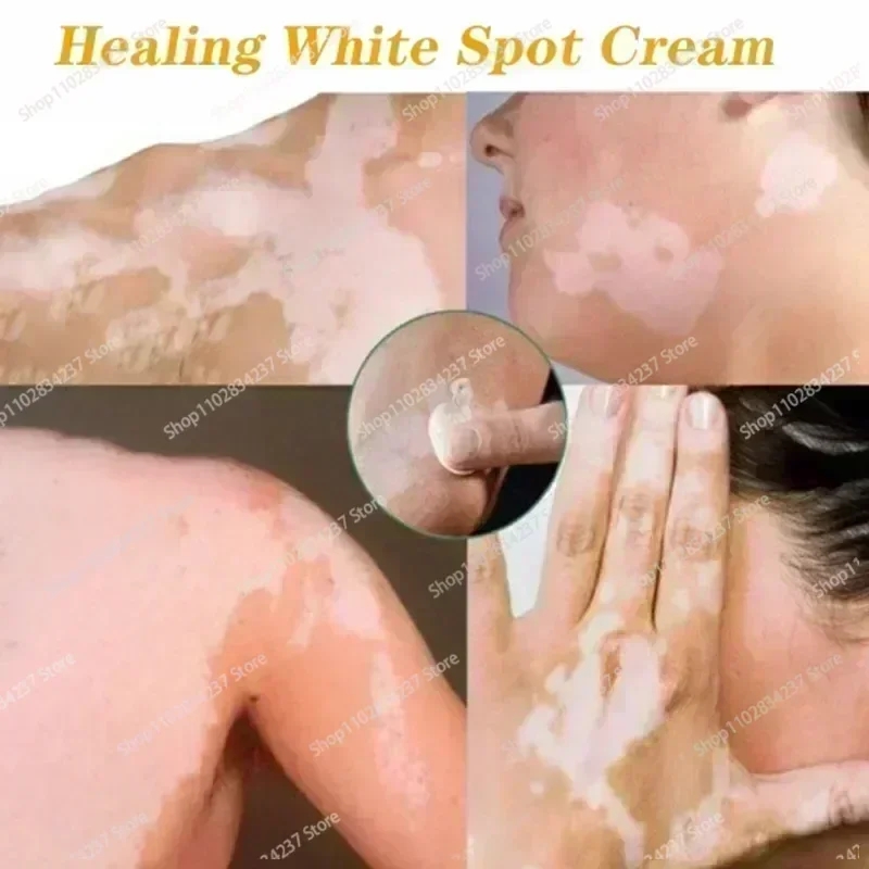 Witte Vlek Hydraterende Crème Vermindert Witte Vlekken Huid Vitiligo Verzorging Huid Vitiligo Verzorging Hydraterende Crème Vermindert Witte Vlekken