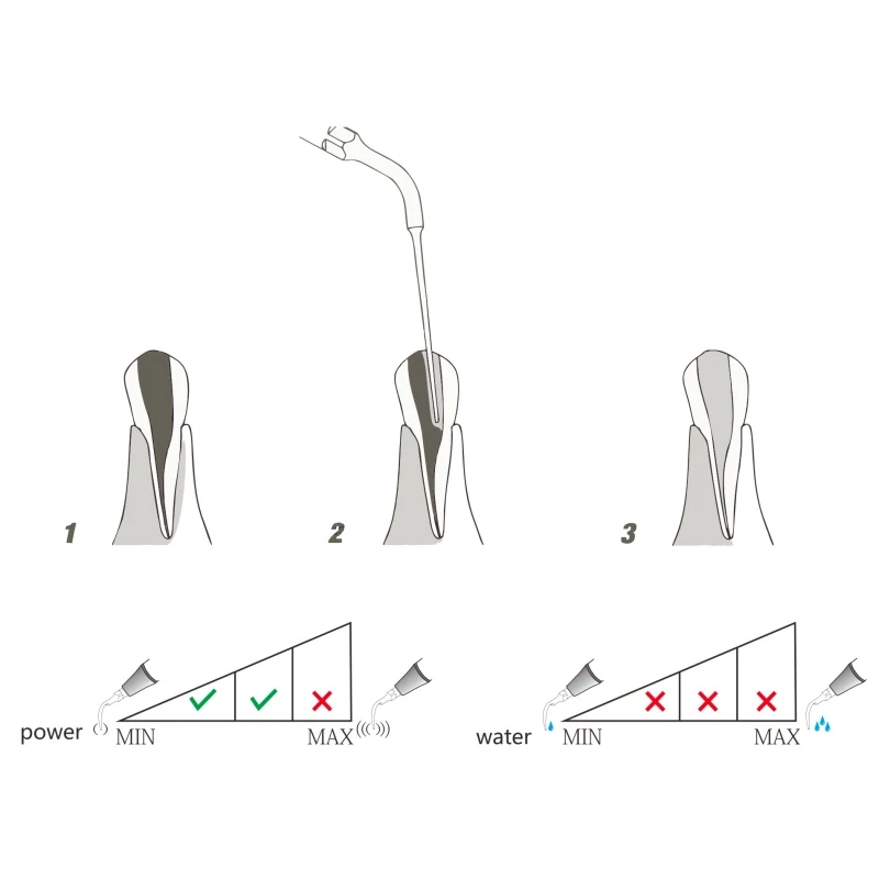 Pièce à main de détartreur à ultrasons E4 pour soins bucco-dentaires, pointe endodontique dentaire, EMS, pic de calcul, élimination du remplissage