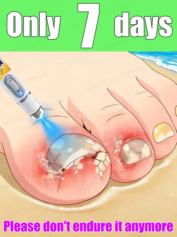 

Say goodbye to onychomycosis and don't let it affect your life