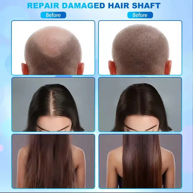 

5 in 1 Hair Scalp Analyzer Hair Loss Treatment Growth Device Scalp Massager 2 HD Digital Microscope Follicle Detector Heads