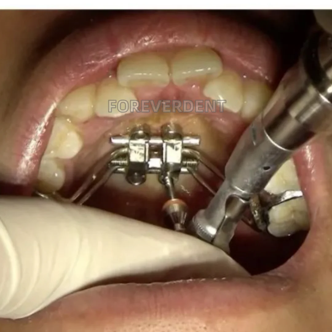 MSE Dental Marpe Palatal Screw Rod Maxillary Skeletal Expander Orthopaedic Mid Facial Parallel Expansion Screw Rod Appliance