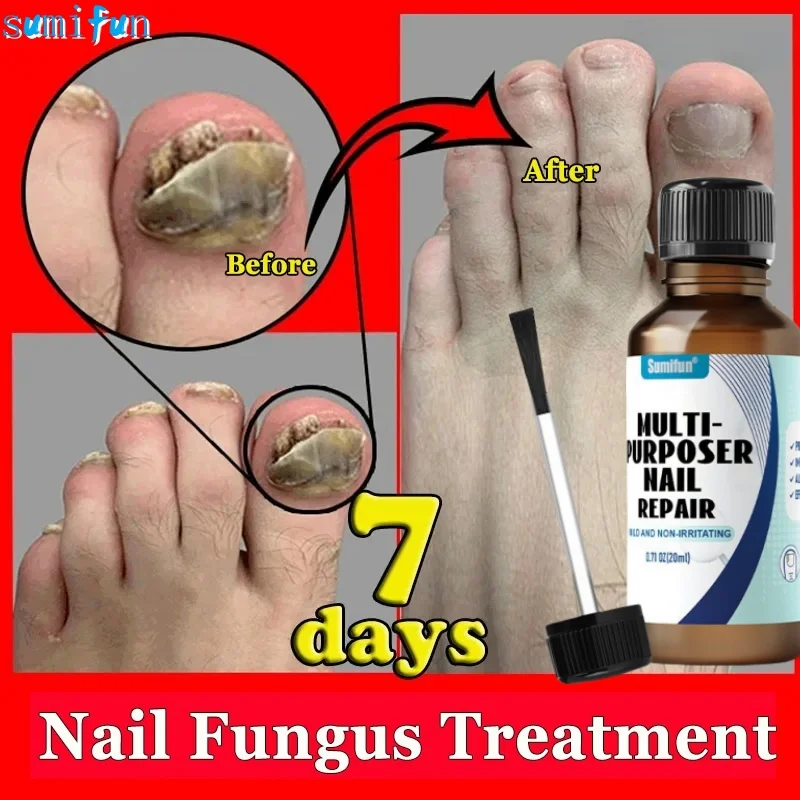 

Fungal Nail Treatment Serum Foot Nail Fungus Removal Repair Gel Anti Infection Paronychia Onychomycosis Foot Nails Care Essence