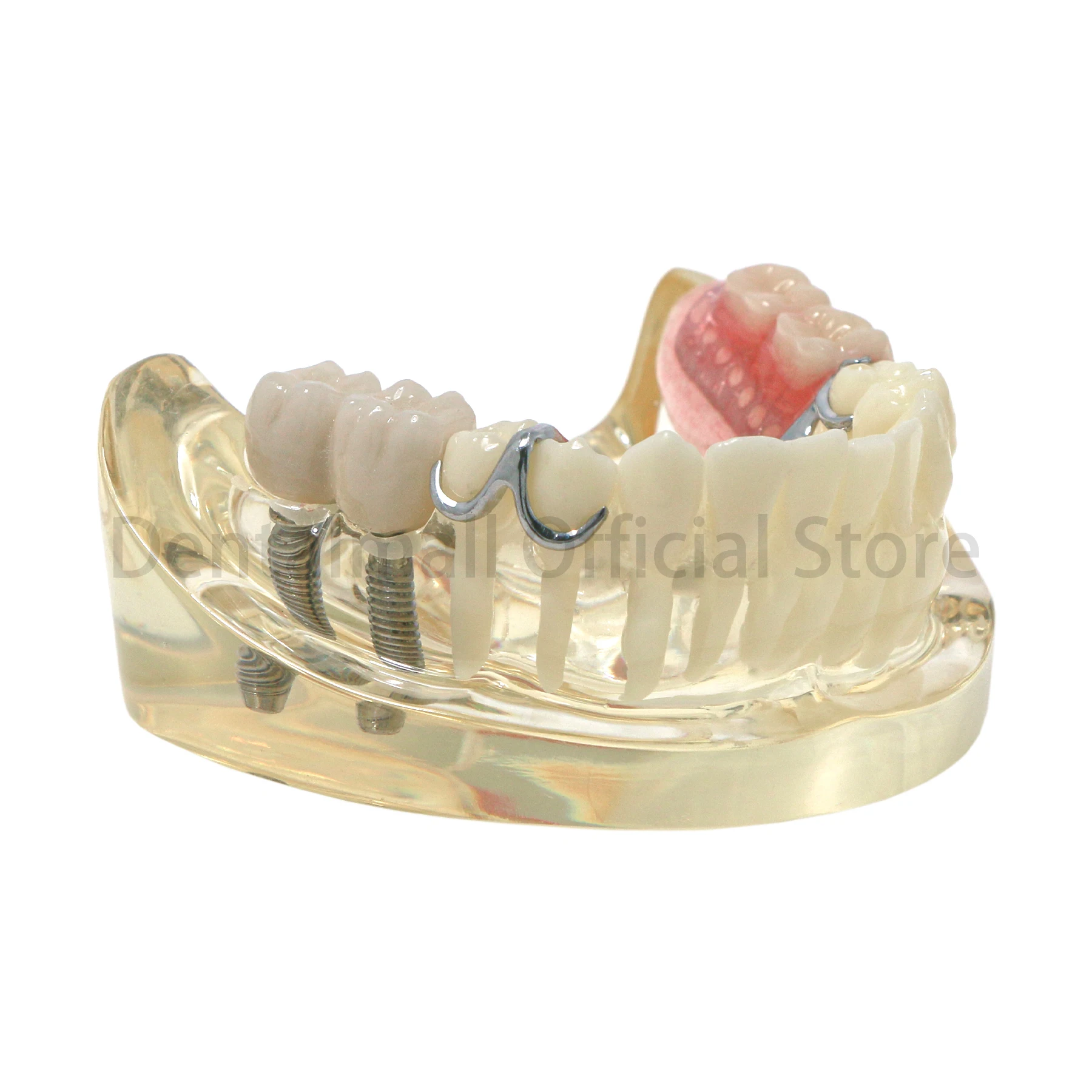 Dental Typodont Restoration Dental Teeth Model with Partial Denture Demo 2 Implants Steel Bracket Model