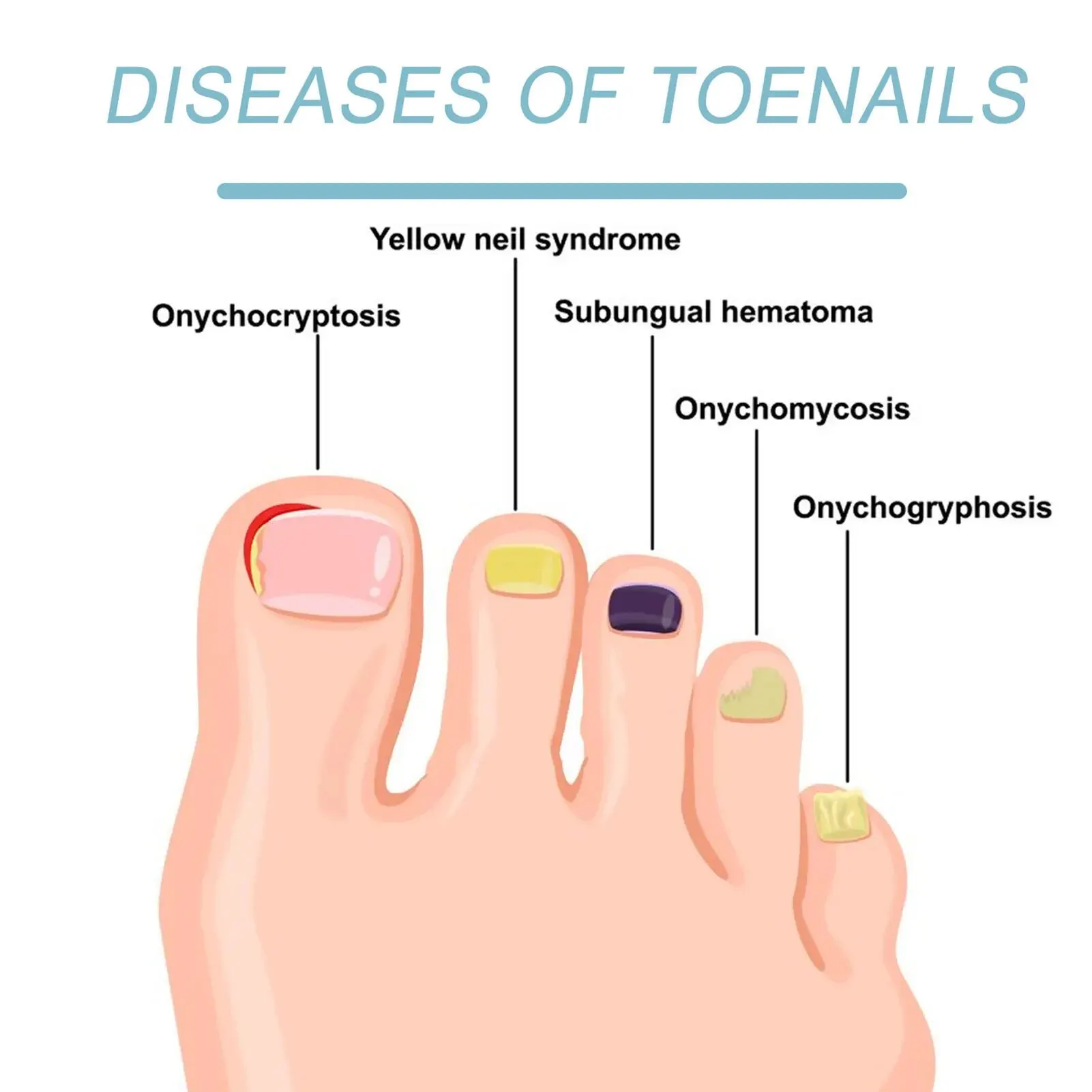 Nail Fungus Laser Treatment Device Professional Onychomycosis Therapy Cure Machine for Broken Cracked Split and Weak Nails