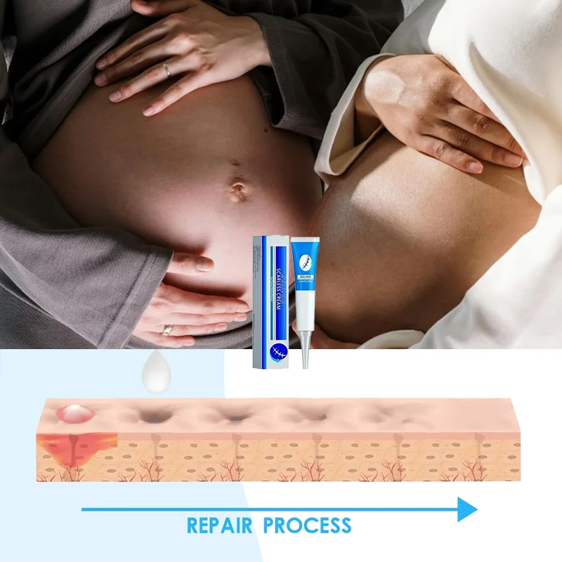 

Maternity Cream Improves Elasticity Skin Care Gentle After Pregnancy Stretch Marks Removal Stretch Marks Highly Effective