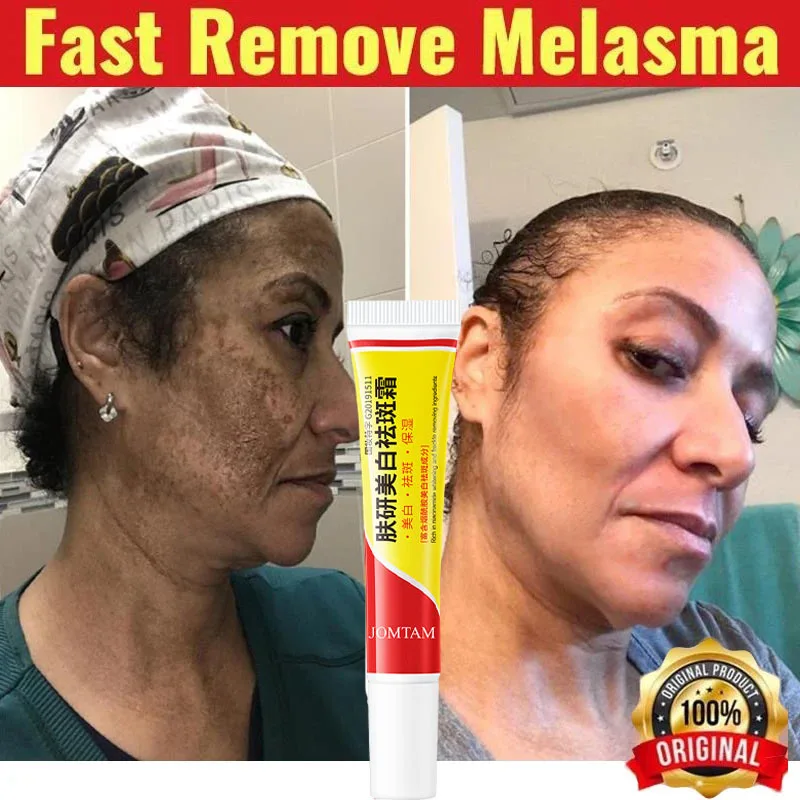 Crema eficaz para pecas, ilumina rápidamente la cara, elimina el Melasma, manchas oscuras, desvanece la melanina, blanquea, antipigmentación, mejora el cuidado del polvo