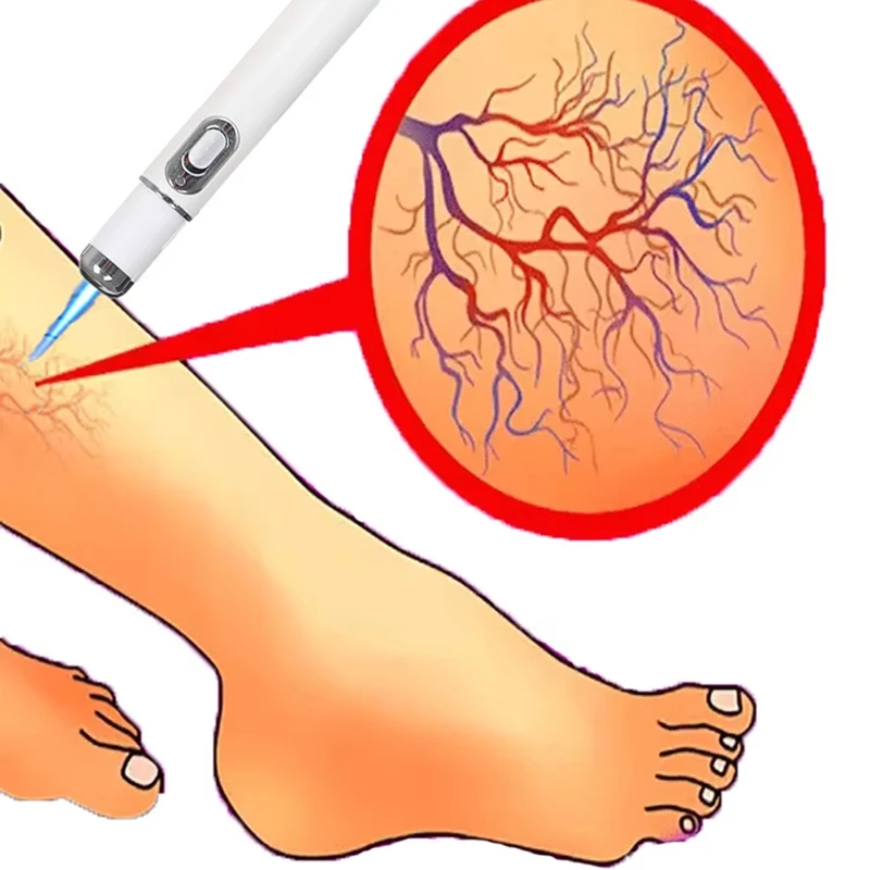 

Laser Pen Soft Scar Scratch Varicose Veins Wrinkle Removal Laser Pen For You