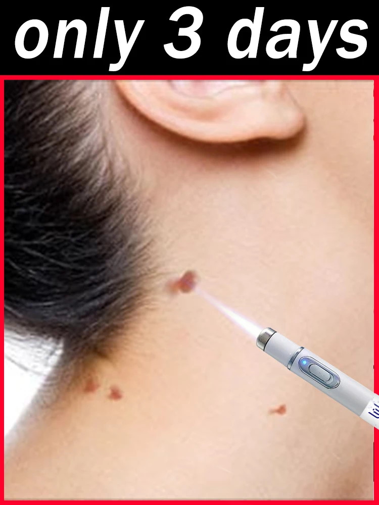 

Generation upgraded wart, repair warts root,quickly 1st