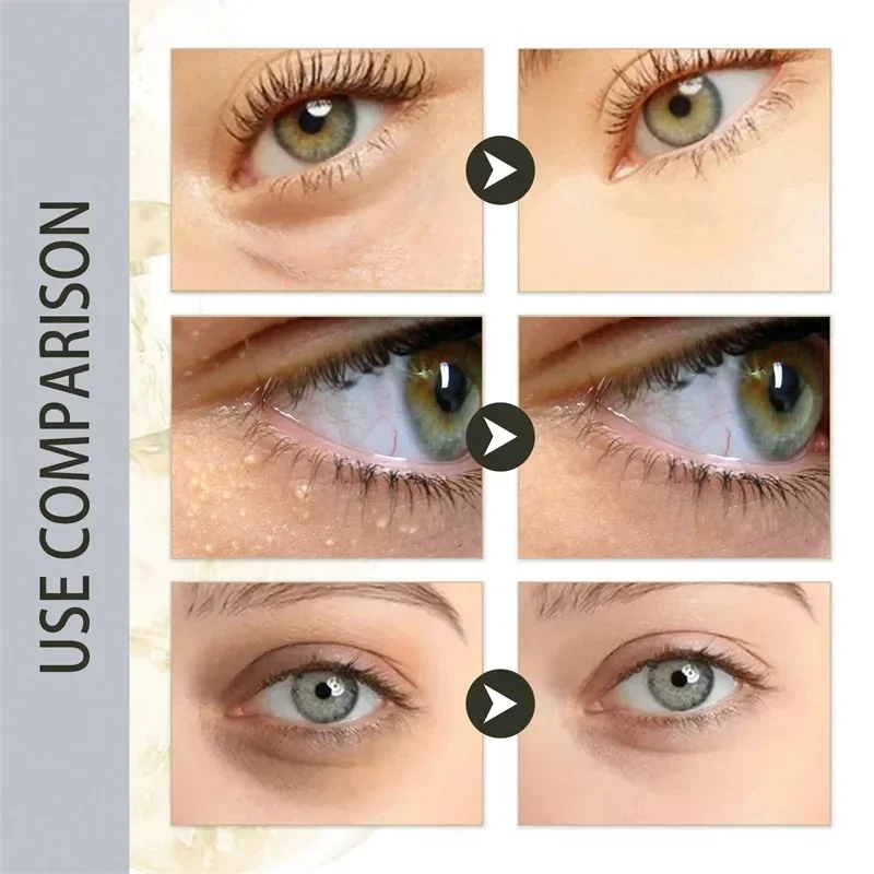 Fat Granules Remover Eye Cream Anti-Puffiness Anti Inflammatory Reduce Dark Circles Eyebags Fade Lines Moisturizing Eye Care New